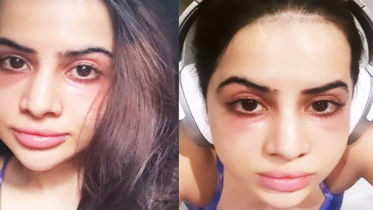 Urfi Javed Got Under Eye-Fillers After Facing Severe Trolling For Dark Circles: ‘Why Did I Do This’